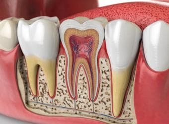 6 Signs You Need A Root Canal