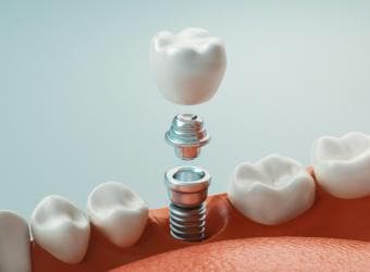 How to Care for New Dental Implants